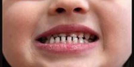 بالبلدي: هل
تصلح
الأسنان
المكسورة
نفسها
كما
يحدث
في
العظام؟