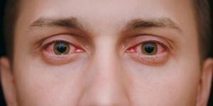 بالبلدي : ما هو مرض التراخوما الذي يصيب العين؟.. احذر الإصابة بالعمى