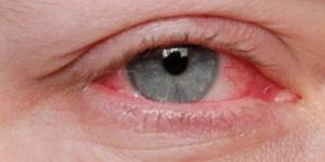 بالبلدي: أعراض أنفلونزا العيون في الخريف