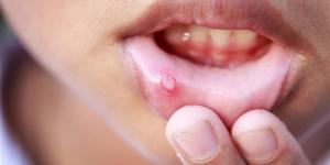 بالبلدي : علاج تقرحات الفم من الصيدلية وخطوات أخرى منزلية.. الملح والطحينة والعسل