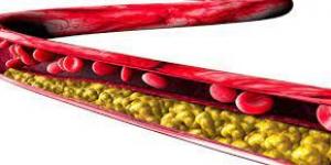 بالبلدي : ما طرق علاج الدهون الثلاثية وأسباب ارتفاعها في الدم؟