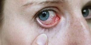 بالبلدي : ما تأثير السكر على العين؟.. أضرار مؤقتة أو دائمة