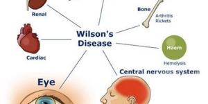 بالبلدي : مرض ويلسون| تعرف على الأعراض والتشخيص