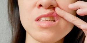بالبلدي: كيف تقى نفسك من التعرض لقرح الفم ؟
