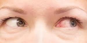 بالبلدي : تطور جديد بشأن العلاج المناعي لسرطان العين النادر.. ما هو؟