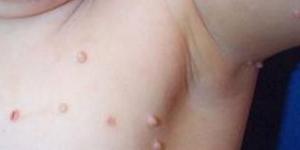 بالبلدي : أسباب ظهور الزوائد الجلدية.. 5 عوامل رئيسية وراء المشكلة