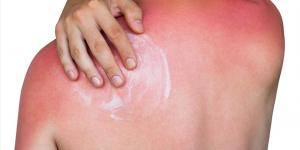 بالبلدي : كيف يمكن لحروق الشمس أن تسبب سرطان الجلد؟