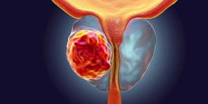 بالبلدي : اختبارات جديدة لاكتشاف الرجال الأكثر عرضة لـ سرطان البروستاتا
