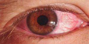 بالبلدي : أسباب التهاب الملتحمة.. احذر هذا المرض المعدي في العين
