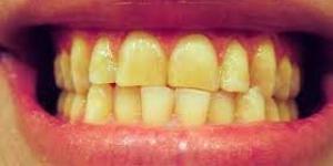 بالبلدي : هل تعاني من اصفرار الأسنان؟.. خطأ شائع يسبب مشكلة