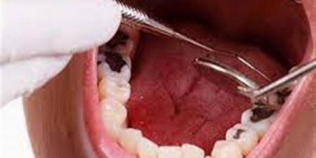 بالبلدي : عادات خاطئة تدمر الأسنان.. بينها قضم الأظافر