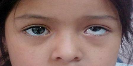 بالبلدي : أسباب كسل العين عند الأطفال.. قصر النظر من بينها