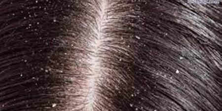 بالبلدي : ما أنواع قشرة الشعر وأسبابها.. وكيف لها فوائد للمخ؟