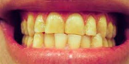 بالبلدي : طبيب يحذر من خطأ يسبب اصفرار الأسنان.. وهذه طرق الوقاية