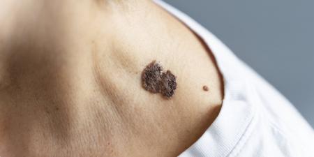 بالبلدي : شهر التوعية بسرطان الجلد.. تعرف على العلامات الشائعة وعوامل الخطر