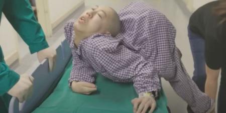 بالبلدي : نجاح الأطباء في علاج شاب صيني أصيب بحالة مرضية خطيرة بالعمود الفقري