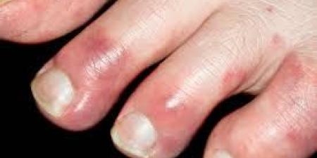بالبلدي : 3 حالات قاتلة.. ما هي دلالات تورم الأصابع؟