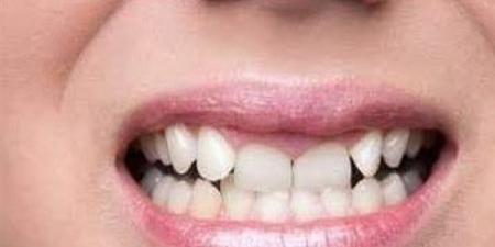 بالبلدي : أمراض منتشرة سببها مشكلة في الأسنان.. أخصائي يكشفها