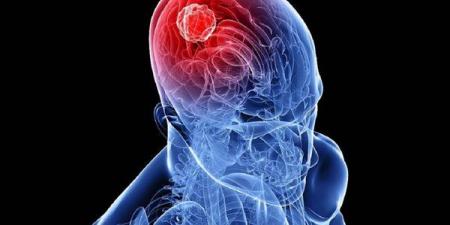 بالبلدي : هل ترتبط أورام المخ بإصابات الرأس؟