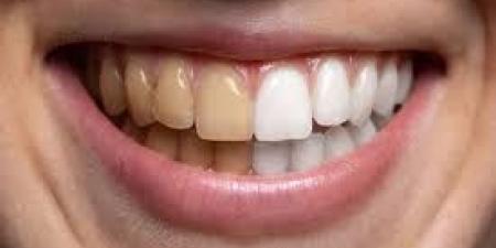 بالبلدي : طبيب أسنان يحذر من الإفراط في تناول هذه الفواكه.. ما السبب؟