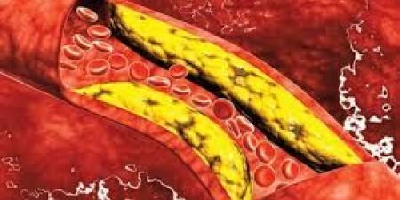 بالبلدي : 3 علامات تشير إلى ارتفاع نسبة الكوليسترول في الدم