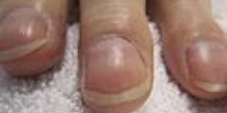بالبلدي : طبيب يحذر من علامة غير عادية تظهر في اليدين
