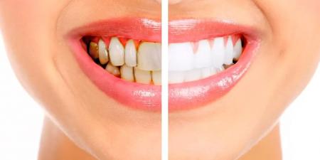 بالبلدي : نصائح ذهبية للحصول على أسنان ناصعة البياض