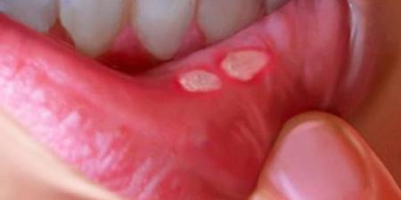 بالبلدي : ما أسباب الإصابة بقرحة الفم؟.. واحذر هذه أبرز أعراضها