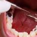 بالبلدي : عادات خاطئة تدمر الأسنان.. بينها قضم الأظافر