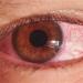 بالبلدي : أسباب التهاب الملتحمة.. احذر هذا المرض المعدي في العين