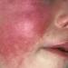 بالبلدي : أخصائية تكشف أعراض الحمى الوردية.. تستمر الحرارة 3 أيام وظهور طفح جلدي