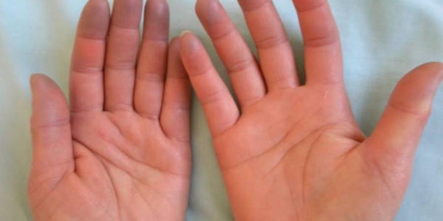 بالبلدي: أمراض تنذرك بها برودة يديك