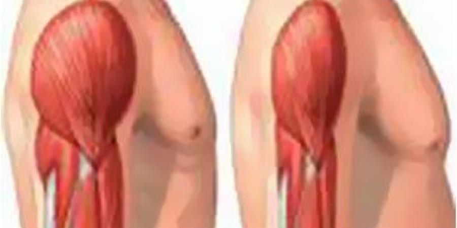 بالبلدي: أشهر أسباب وأعراض تيبس العضلات