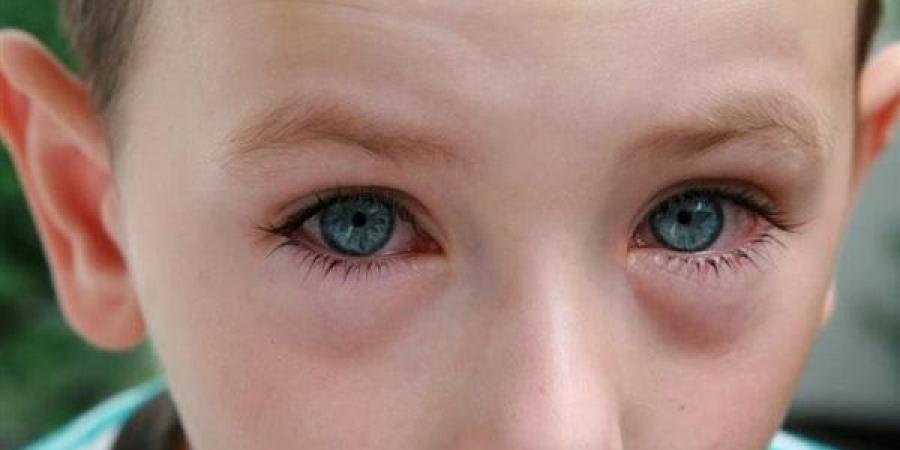بالبلدي : أعراض الرمد الربيعي عند الأطفال.. استشاري: بينها احمرار ودموع بالعيون