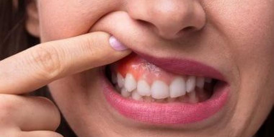 بالبلدي: علامات ظاهرة وعوامل تزيد فرص الإصابة بتقرحات الفم والشفاه