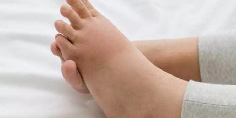 بالبلدي : أسباب تورم القدم اليمنى عند النساء.. أخطرها أمراض الكبد