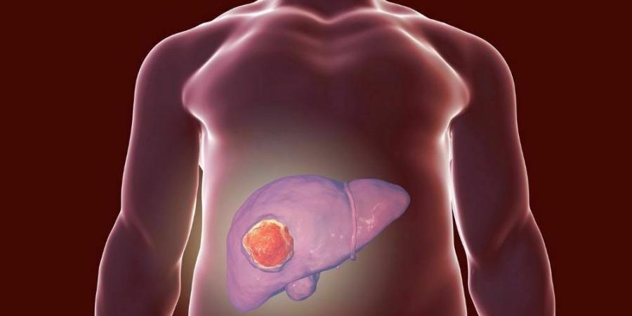 بالبلدي : ما العلاقة بين الكبد الدهني وخطر الإصابة بالسرطان؟.. طبيب يُجيب