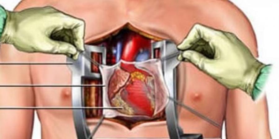 بالبلدي : نصائح ضرورية قبل إجراء عملية القلب المفتوح.. أبرزهم التوقف عن الأسبرين
