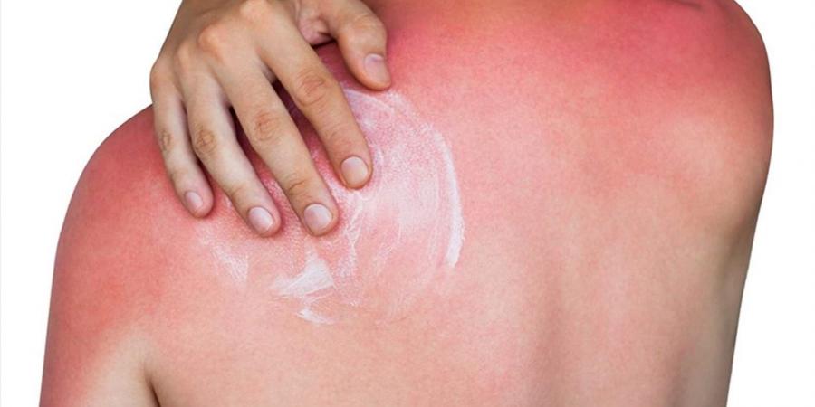 بالبلدي : كيف يمكن لحروق الشمس أن تسبب سرطان الجلد؟