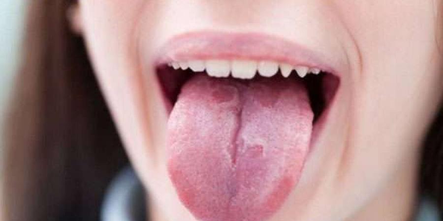 بالبلدي : ما هي متلازمة الفم الحارق‏؟.. استشاري يجيب