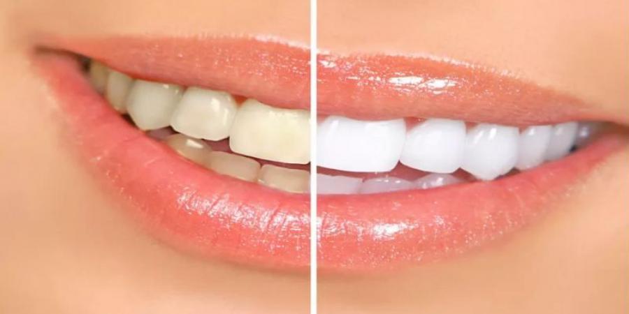 بالبلدي: نصائح فعّالة للحفاظ على بياض الأسنان والابتسامة الجميلة