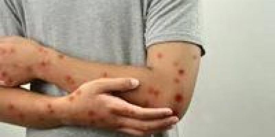 بالبلدي : الصحة
      العالمية:
      جدرى
      القرود
      يتفشى
      فى
      49
      دولة
      ويصيب
      6823
      ألفا
      مع
      16
      حالة
      وفاة