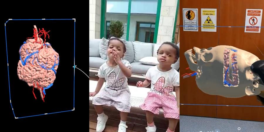 belbalady بمساعدة الذكاء الاصطناعي.. فصل توأم ملتصق في عملية جراحية معقدة استغرقت 40 ساعة